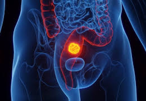 Tại sao mổ ung thư trực tràng phải vét hạch lympho